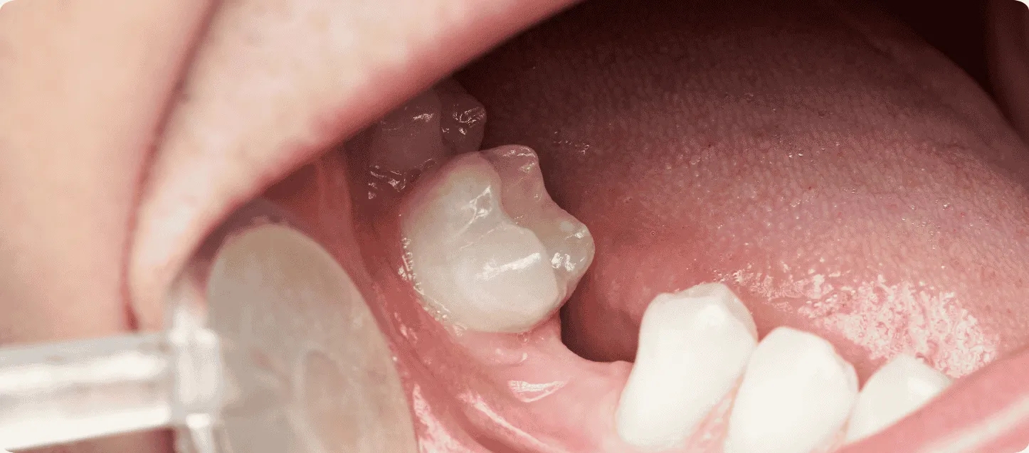 Treatment-4